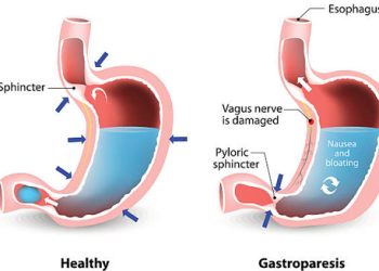Medical illustration comparing a healthy stomach to one with gastroparesis highlighting vagus nerve damage