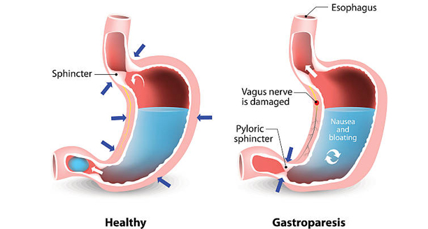 Medical illustration comparing a healthy stomach to one with gastroparesis highlighting vagus nerve damage