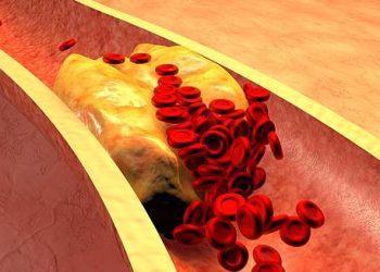 Illustration of blocked artery showing blood cells and plaque buildup, symbolising causes of Giant Cell Arteritis