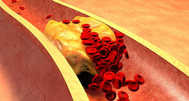 Illustration of blocked artery showing blood cells and plaque buildup, symbolising causes of Giant Cell Arteritis