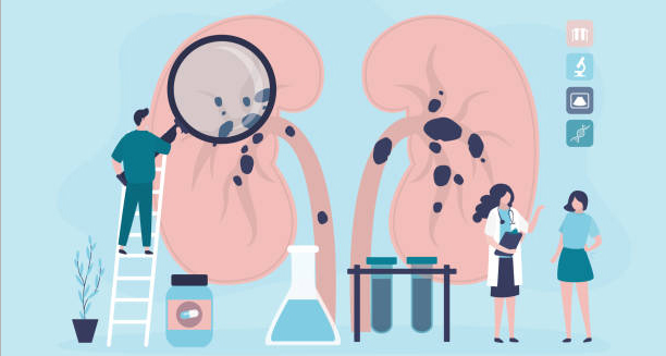 Illustration showing causes of glomerulonephritis with damaged kidneys