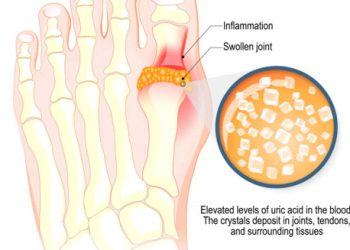 Illustration showing uric acid crystal buildup in the toe joint causing gout
