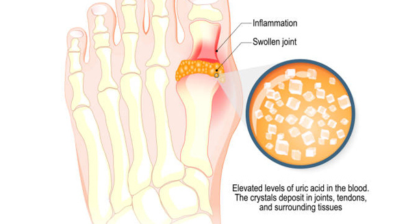 Illustration showing uric acid crystal buildup in the toe joint causing gout