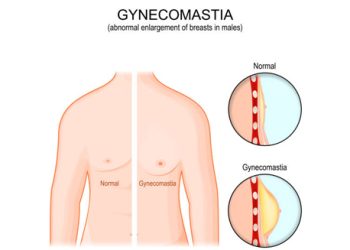 Medical illustration comparing normal male chest with gynaecomastia