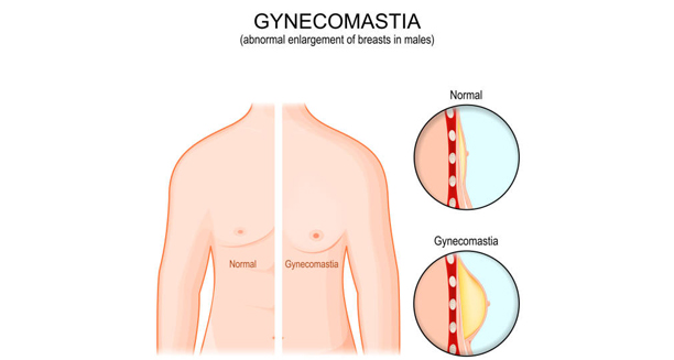 Medical illustration comparing normal male chest with gynaecomastia