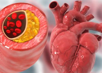 3D medical illustration of a blocked artery and human heart showing causes of heart rhythm problems