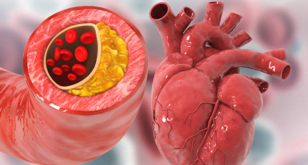 3D medical illustration of a blocked artery and human heart showing causes of heart rhythm problems
