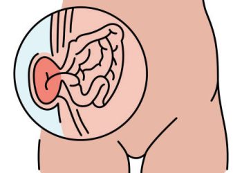 Medical illustration showing abdominal hernia with intestines pushing through the abdominal wall