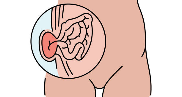 Medical illustration showing abdominal hernia with intestines pushing through the abdominal wall