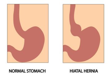 3D illustration of antibodies possibly linked to the causes of Henoch-Schönlein Purpura