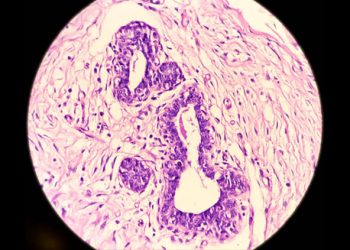 Microscopic image showing hair follicle and skin tissue inflammation related to hidradenitis suppurativa