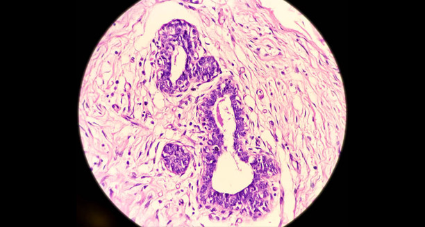 Microscopic image showing hair follicle and skin tissue inflammation related to hidradenitis suppurativa