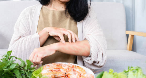 Woman scratching hives on her arm after eating shrimp