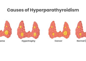 Diagram showing common causes of hyperparathyroidism including adenoma, hypertrophy, and cancer