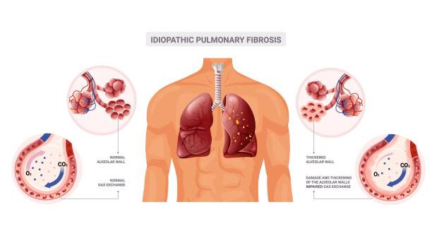 Medical illustration showing lungs affected by idiopathic pulmonary fibrosis and alveolar damage