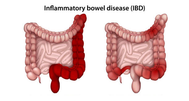 Diagram comparing two intestines affected by inflammatory bowel disease (IBD)