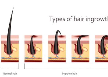 Causes of Ingrown Hairs