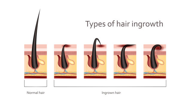 Causes of Ingrown Hairs