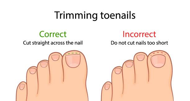 Causes of Ingrown Toenail