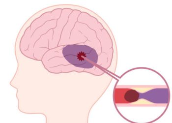 Medical illustration of a brain with blocked blood flow causing increased pressure