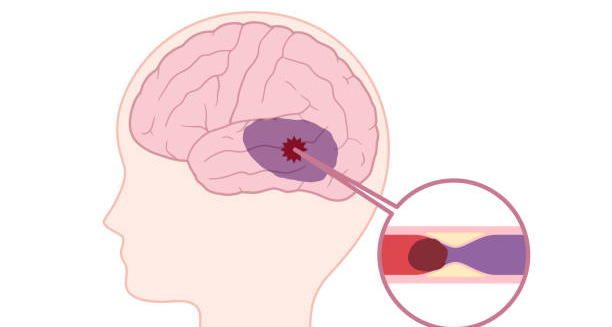 Medical illustration of a brain with blocked blood flow causing increased pressure