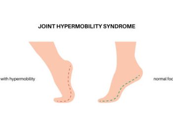 Illustration comparing a hypermobile foot and a normal foot in Joint Hypermobility Syndrome