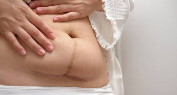 Abdominal scar after surgery indicating potential keloid formation