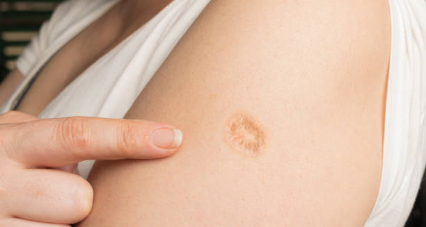 Healed scar from a graze on upper arm