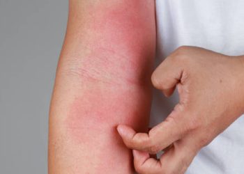 Person scratching red, inflamed rash on forearm due to allergic reaction
