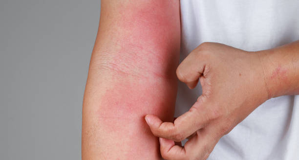 Person scratching red, inflamed rash on forearm due to allergic reaction