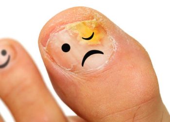 Toenail with fungal infection and cartoon sad face