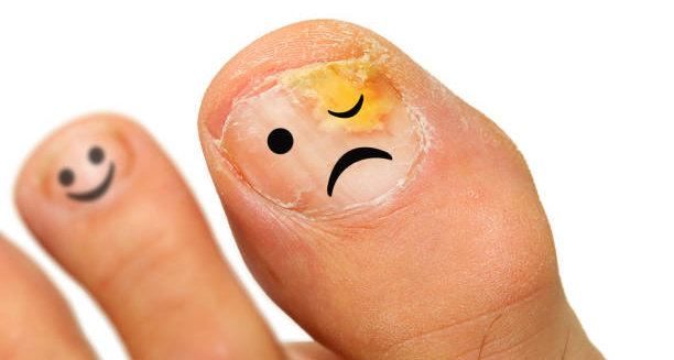 Toenail with fungal infection and cartoon sad face