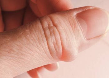 Close-up of a ganglion cyst on the thumb showing swelling and tension