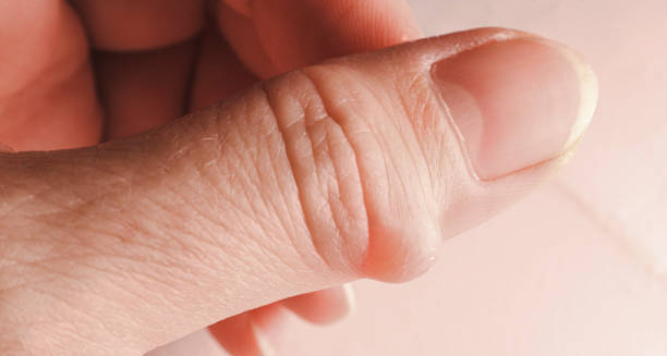 Close-up of a ganglion cyst on the thumb showing swelling and tension