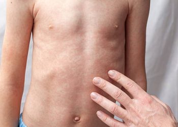 Complications of German Measles