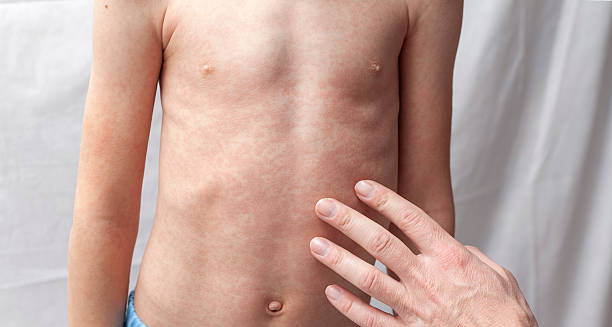 Complications of German Measles