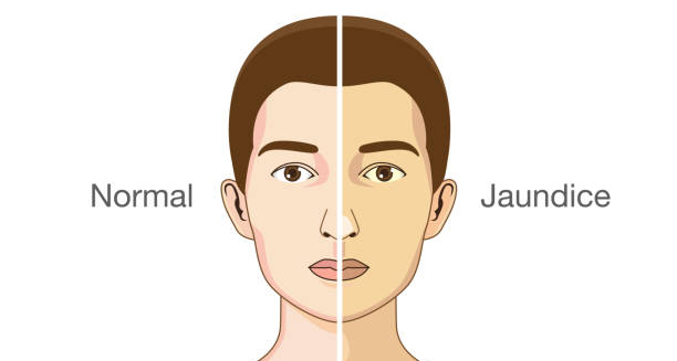 Comparison illustration of normal vs jaundiced skin tone in Gilbert’s Syndrome