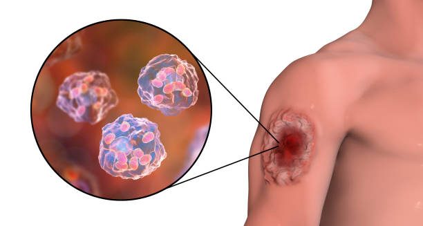 Granulomatosis with polyangiitis skin lesion and neutrophil inflammation