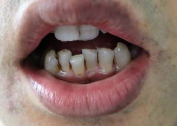 Visible gum recession and misaligned teeth as complications of gum disease