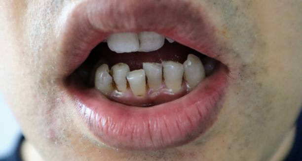 Visible gum recession and misaligned teeth as complications of gum disease