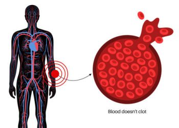 Diagram showing blood that doesn’t clot and potential haemophilia complications.