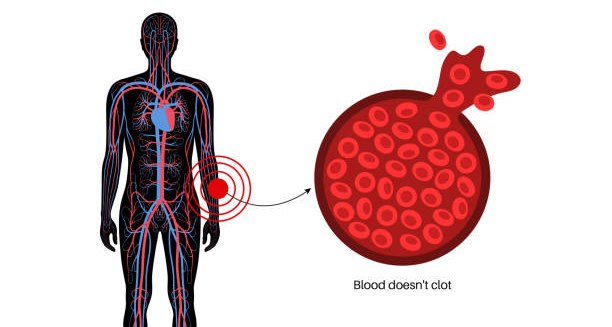 Diagram showing blood that doesn’t clot and potential haemophilia complications.