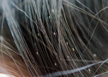 Close-up of hair strands with visible head nits attached near the scalp