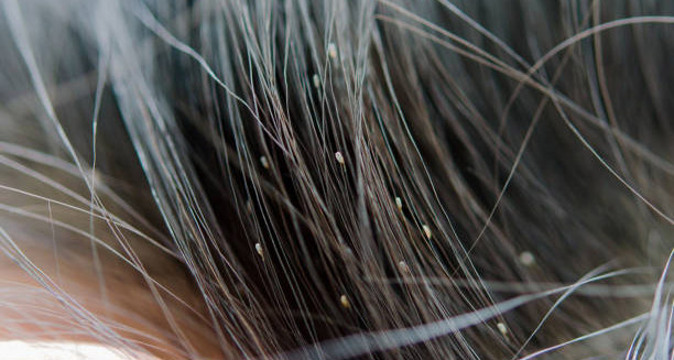 Close-up of hair strands with visible head nits attached near the scalp