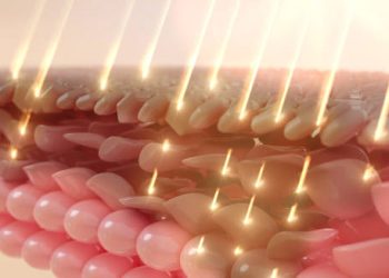 Close-up 3D skin layers with heat rays penetrating the surface, illustrating complications of heat rash