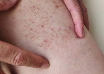 Skin showing purpuric rash as a complication of Henoch-Schönlein Purpura