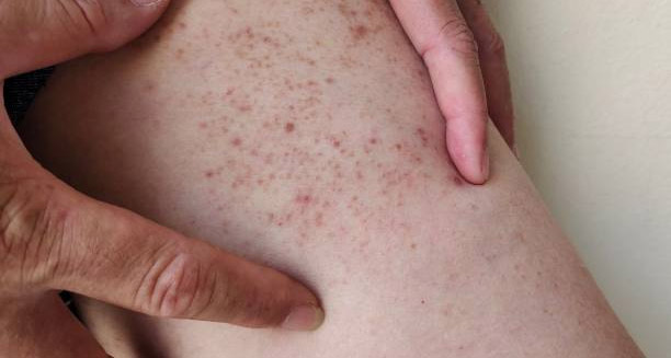Skin showing purpuric rash as a complication of Henoch-Schönlein Purpura