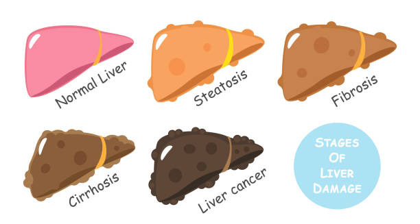Illustration showing stages of liver damage from normal liver to liver cancer