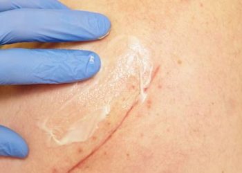 Close-up of gloved hand applying cream to scarred skin after hidradenitis suppurativa surgery