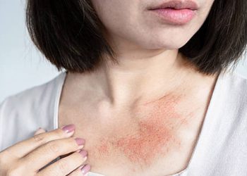 Woman with severe hives rash on her chest caused by allergic reaction